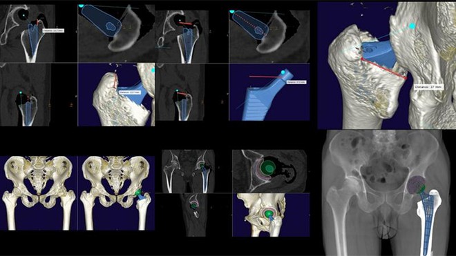 Vinmec: Ứng dụng thành công kỹ thuật ‘cá thể hóa’ thay khớp háng ‘4 không’ ảnh 1