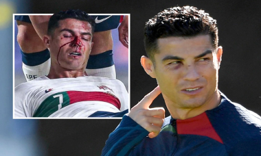 Ronaldo đến sân tập với một mắt bầm tím