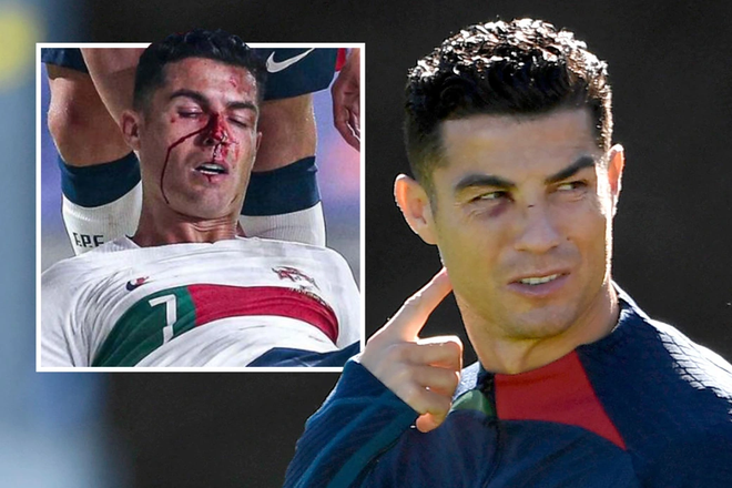 Ronaldo đến sân tập với một mắt bầm tím ảnh 1